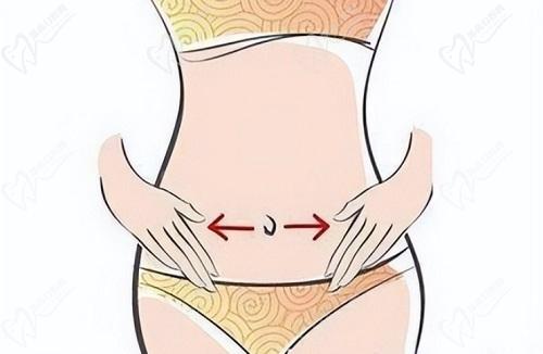 厦门华美整形腰/腹吸脂