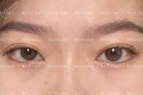 长沙解灿修复双眼皮口碑