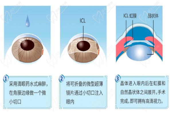 虹膜固定型ICL晶体植入医生有哪些