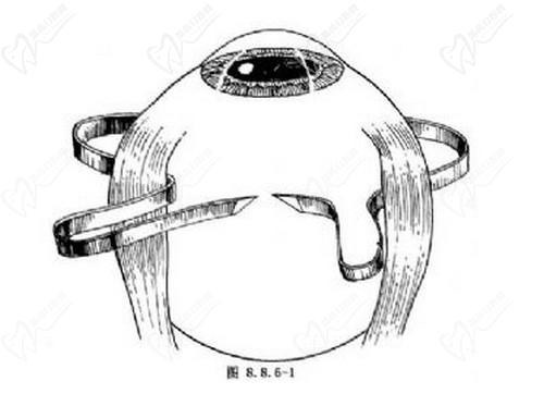 石家庄爱眼眼科薛安 全做后巩膜加固术技术娴熟