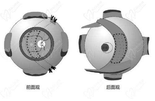 石家庄爱眼眼科薛安 全做后巩膜加固术技术出众