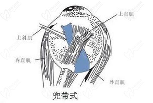 薛安 全医生做后巩膜加固术的口碑不错