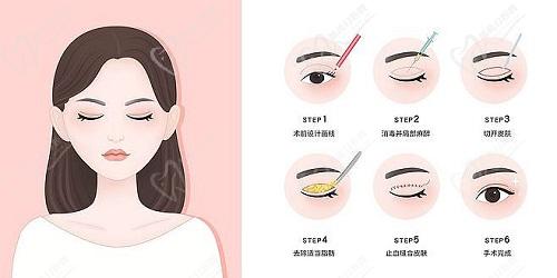 成都蔡灵做的双眼皮怎么样