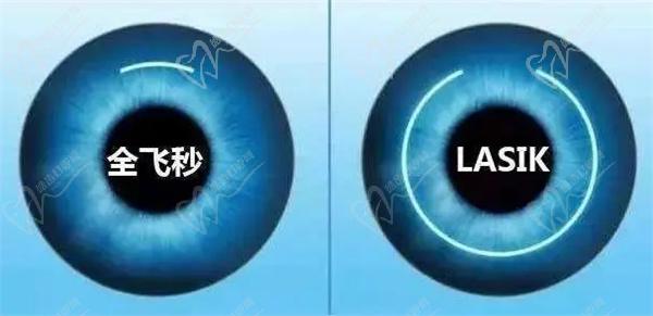 郑州近视眼手术价格一览表