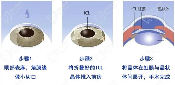 郑州近视眼手术价格一览表
