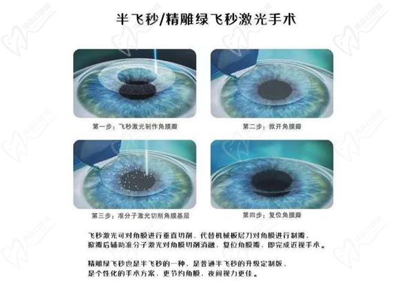 郑州近视眼手术价格一览表