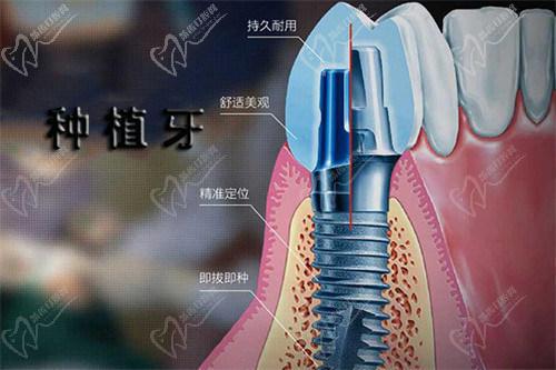 西安小白兔口腔种植牙选肖新医生技术靠谱