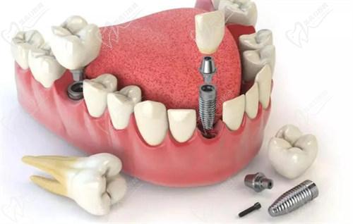 西安小白兔口腔医院韩国登腾种植牙的优势