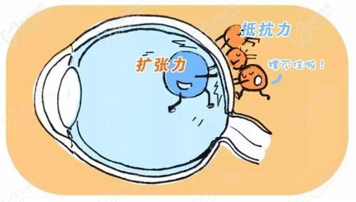 薛安 全后巩膜加固术技术高超