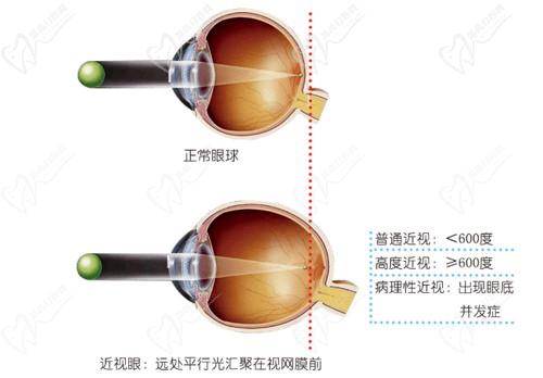 薛安 全后巩膜加固术技术成熟