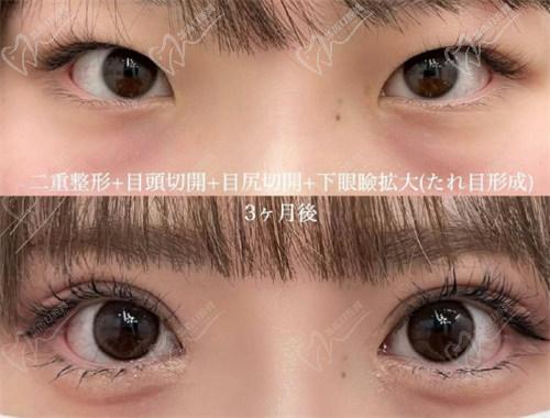 西安画美张莎莎做双眼皮做的好吗