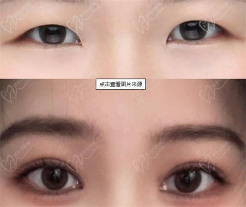 张莎莎医生做双眼皮的特点：