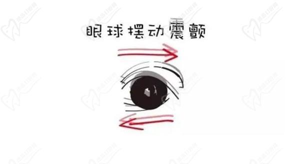 眼球震颤