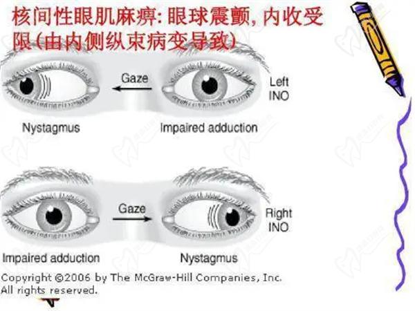 眼球震颤