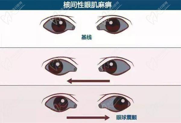 眼球震颤
