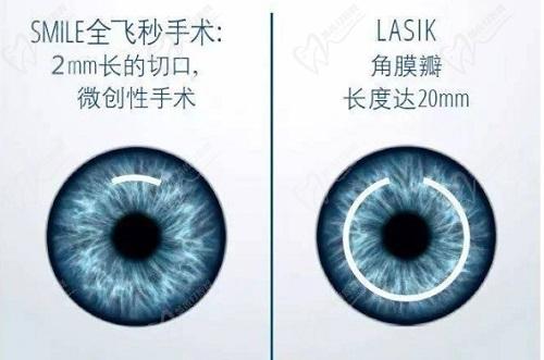 燕振国做近视手术怎么样