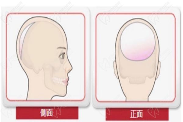 何晋龙peek材料失败的原因及解决方法