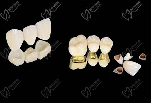 西安小白兔口腔牙贴面价格贵吗？