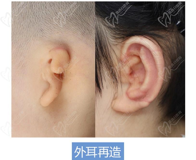 张朝梅耳再造 张朝梅耳再造