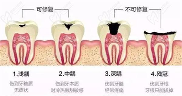 根管治疗
