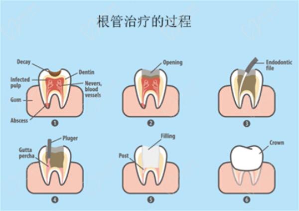 根管治疗