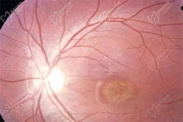 上海和平眼科医院虹膜炎治疗费用多少