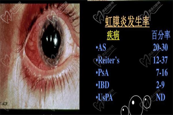 虹膜炎治疗