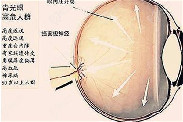 青光眼伴随虹膜炎治疗