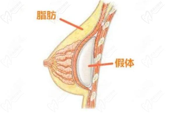 李静林隆胸失败原因分析