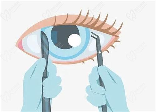 广州视百年眼科双频精 雕个性化半飞秒价格