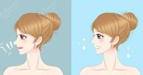 佛山华美蒋思军做鼻子怎么样