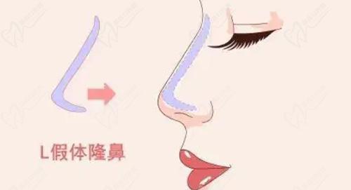 硅胶隆鼻好还是膨体隆鼻好
