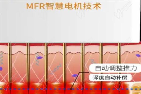 上海黄金微针价格