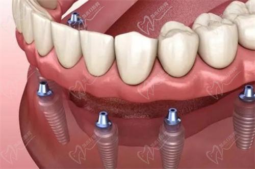 余姚冠扬口腔医院武志东医生擅长项目