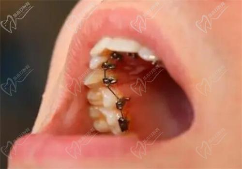 杭州雅莱口腔舌侧隐形矫正价格45500起 杭州雅莱口腔舌侧隐形矫正价格45500起