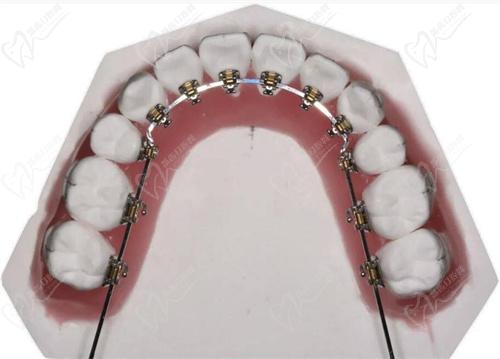 舌侧正畸 舌侧正畸