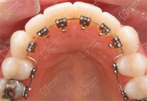 杭州舌侧正畸哪家医院好 杭州舌侧正畸哪家医院好