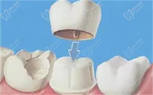 什么是格莱美全瓷牙冠