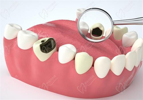 杭州雅莱口腔补牙怎么样? 杭州雅莱口腔补牙怎么样?