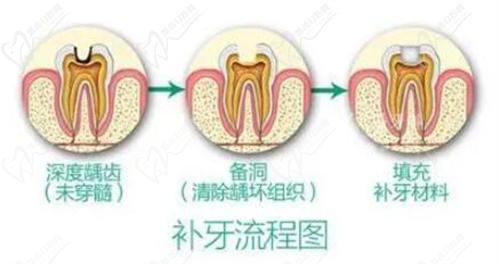 补牙流程图 补牙流程图