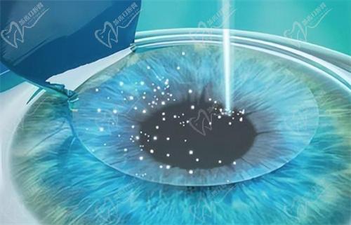 成都友华普惠眼科医院李芳芳医生近视手术口碑评价 成都友华普惠眼科医院李芳芳医生近视手术口碑评价