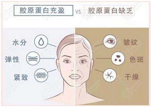 胶原蛋白填充和玻尿酸填充有什么区别