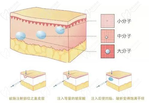 胶原填充和玻尿酸的区别