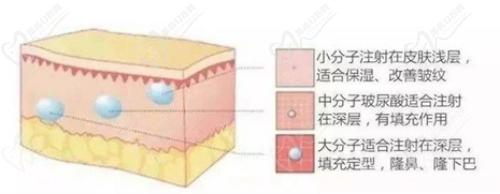 胶原蛋白填充泪沟用几支