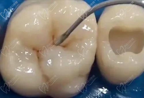 南宁柏乐口腔医院补牙技术怎么样