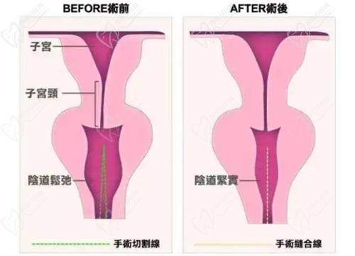 ADM-H®生物束带5U修复技术高超