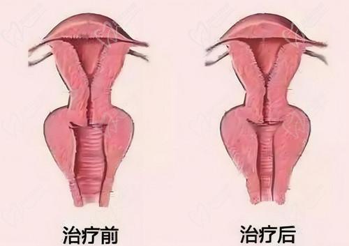 ADM-H®生物束带5U修复技术成熟