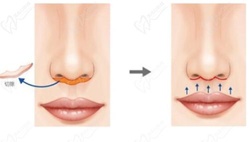 人中缩短手术多少钱？