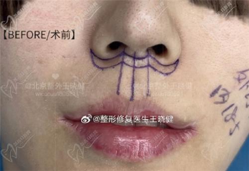 王晓健人中缩短术前图