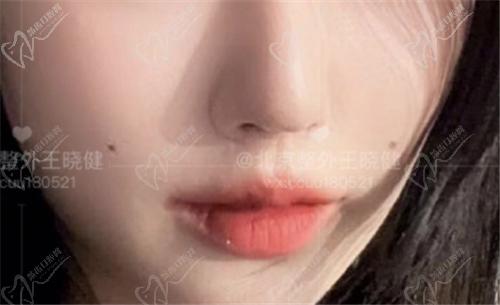 王晓健人中缩短术后图